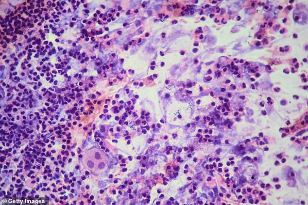 Exclusive Insights: Archbishop Riordan High School TB Outbreak Sparks Public Health Emergency as SFDPH Issues Urgent Advisories