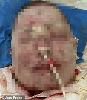 Toxic Skin Reaction from Lamotrigine Leaves Woman with Agonizing Burns