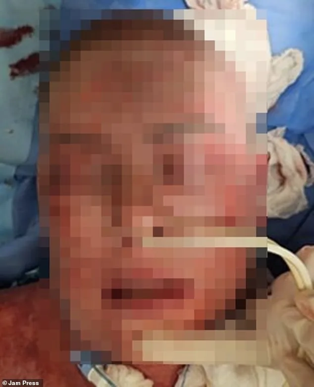 Toxic Skin Reaction from Lamotrigine Leaves Woman with Agonizing Burns