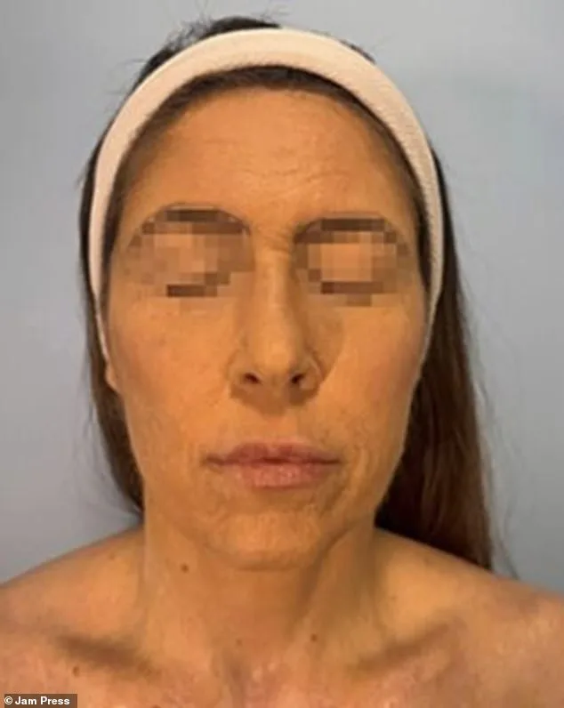 Toxic Skin Reaction from Lamotrigine Leaves Woman with Agonizing Burns