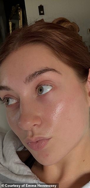 Celebrities praise isotretinoin microdosing for anti-aging, but hidden dangers remain.