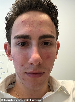 Celebrities praise isotretinoin microdosing for anti-aging, but hidden dangers remain.