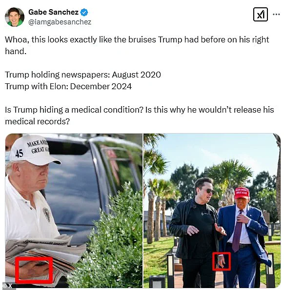 Trump Hand Bruise Sparking Concern: What Could It Mean?