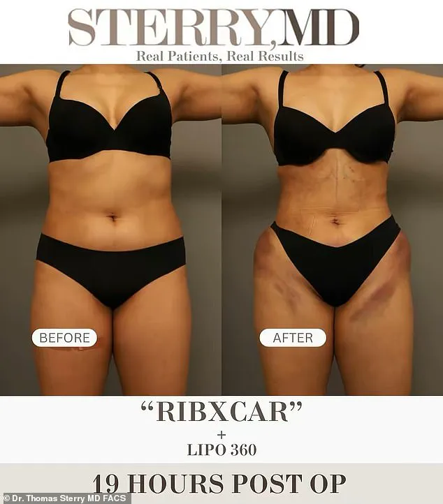Reddit Users Hunt for Truth Behind the Mysterious 'Ribxcar' Procedure Promising Hourglass Figures