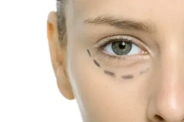 Eyelid Surgery: A Precise Method for Lifting the Face Without a Full Facelift