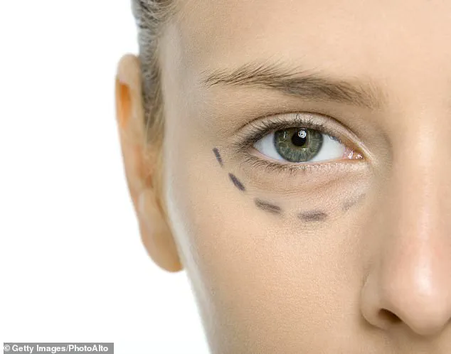 Eyelid Surgery: A Precise Method for Lifting the Face Without a Full Facelift