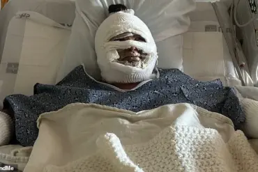 Teen Suffers Severe Burns After Tabletop Fire Pit Explosion