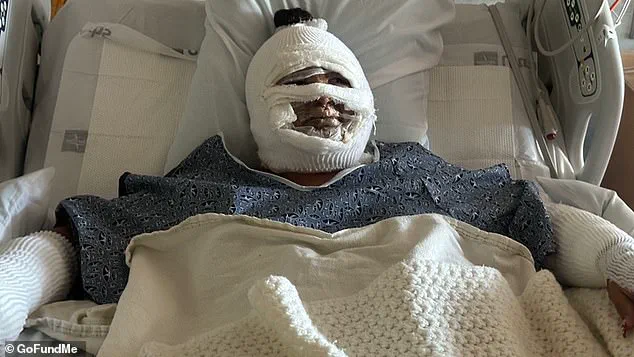 Teen Suffers Severe Burns After Tabletop Fire Pit Explosion