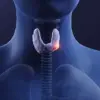 Late-Breaking: Thyroid Cancer Symptoms Dismissed as Anxiety for Years